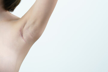 Woman showing keloids or scar on the armpit after breast surgery with caliper, breast implant...