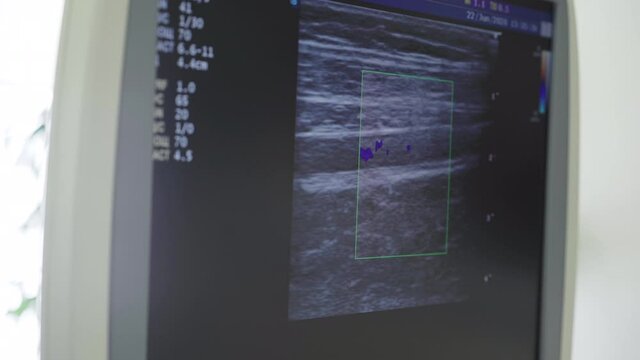 Close-up screen of joint ultrasound. Medical equipment working in hospital. Medicine, bones examination, rheumatology, health care concept.