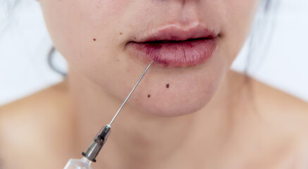 Plastic lips. Women's lips after injections of hyaluronic acid. Complications after lip...