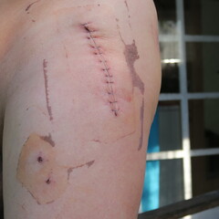 scar with staples, after the use of an artificial hip