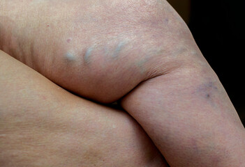 Enlarged varicose veins on a leg of a senior woman, phlebology concept.