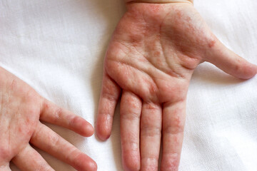 Red rash in the form of blisters on children's hands, rashes with infectious viral diseases