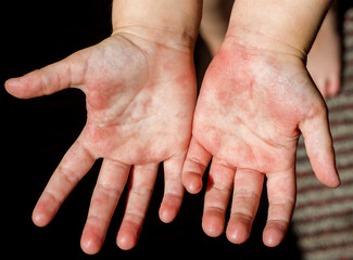 Red rash on the hands of the palms of the child, rubella scarlet fever Coxsackie and other...