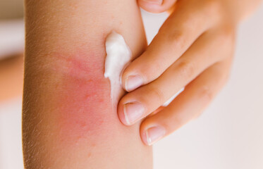 The child smears cream on the skin irritation. Care of the skin.