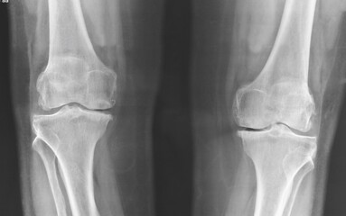 X-ray image of a knee 