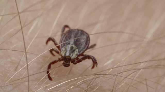 Blood-sucking mite tick creepes on the human skin through the hair
