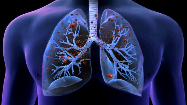Realistic 3D footage animation of the severe acute respiratory syndrome coronavirus 2 (SARS-CoV-2)  known as 2019-nCoV. Lungs contagion. Novel coronavirus close up.High quality medical animation.