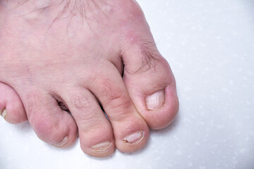 Male nails destroyed by onycholysis. Damage to the male foot nails. At the dermatologist doctor....