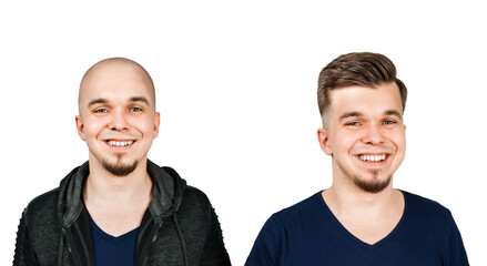 Man before and after transplant hair and alopecia. Isolated on white background