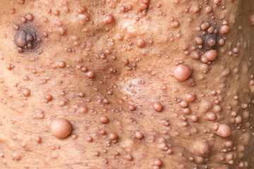 Close up of Neurofibromatosis (NF) is conditions in which tumors grow symptoms include light brown...