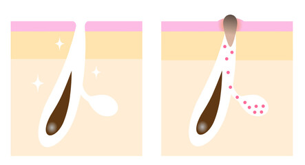 黒ずみ毛穴　ビフォアアフター　肌の断面図
