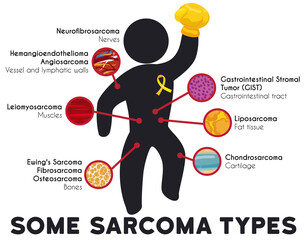 Infographic Showing Some Sarcoma Types and Principal Affected Tissues, Vector Illustration