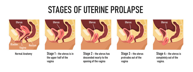 Stages of uterine prolapse. Vector illustration - obrazy, fototapety, plakaty