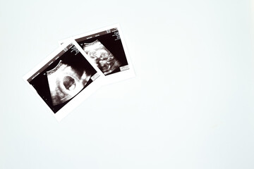 Result of ultrasound picture or ultrasonography for pregnancy on top of white isolated background