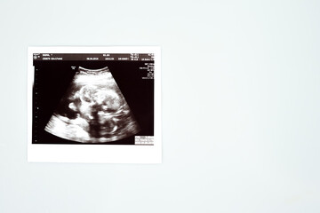 Result of ultrasound picture or ultrasonography for pregnancy on top of white isolated background