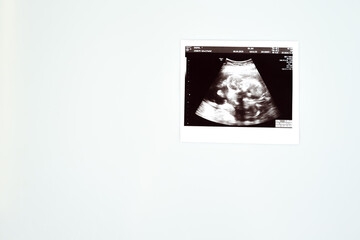 Result of ultrasound picture or ultrasonography for pregnancy on top of white isolated background