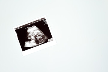 Result of ultrasound picture or ultrasonography for pregnancy on top of white isolated background
