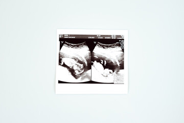 Result of ultrasound picture or ultrasonography for pregnancy on top of white isolated background