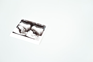 Result of ultrasound picture or ultrasonography for pregnancy on top of white isolated background