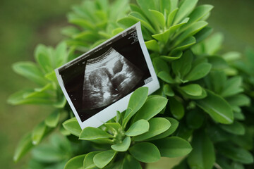 Result of ultrasound picture or ultrasonography for pregnancy.