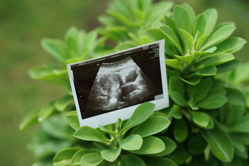 Result of ultrasound picture or ultrasonography for pregnancy.