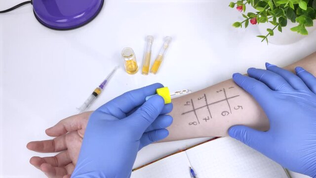 An allergist doctor in the laboratory conducts a prik allergy test. Skin test for household, food, epidermal allergic reactions