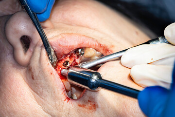 Insertion of Dental Implants into a Patient's Upper Jaw.