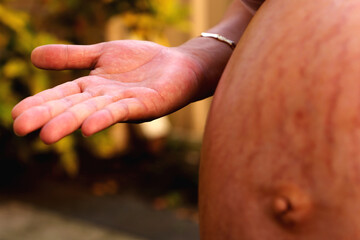 Pregnant woman with open palm hand beside her baby bump with stretch marks. - obrazy, fototapety, plakaty