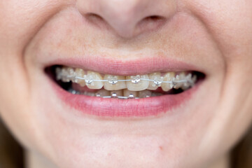 Braces on the teeth. The girl smiles showing her braces on her teeth.