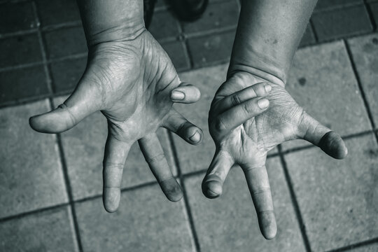 Numbness in the hands of a sick person, locomotor disorder of muscles and tendons