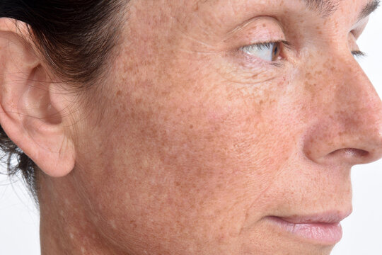 the skin of the face of a forty-five-year-old woman.