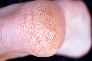 Dry skin on the feet