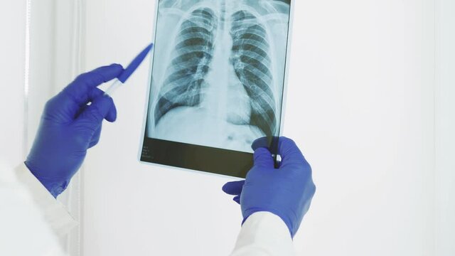 X-ray of the lungs in the hands of a doctor.Doctor looking at an x-ray in the surgical room.Diagnose pneumonia,pulmonary edema in a photo picture.Study x-ray.