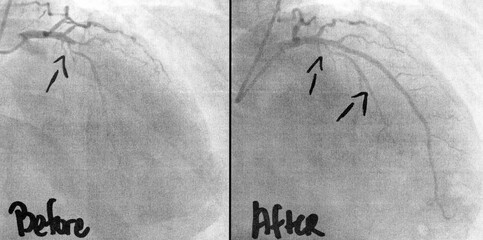 Coronary Angiogram imaging showing before and after three stents, ballooning of two occlusions was performed by a cardiac surgeon.  a life saving intervention for the 54 year old man.