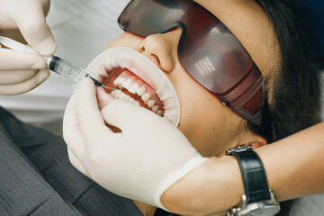 Application of protective whitening gel to the teeth. Woman with an expander in mouth at the dental clinic. Beautiful smile. The health of teeth. Dentist stomatologist whitening teeth for patient.