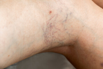 Fototapeta premium Varicose veins on female legs Vascular disease problems from active life concept.