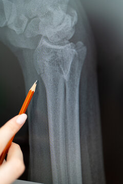 X-ray of a broken arm in a gypsum. The doctor shows the patient the location of the injury. A picture of a human skeleton