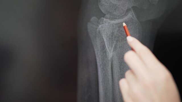 X-ray of the arm bone. Radiologist examines the crack