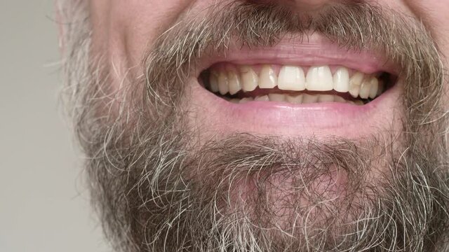 Close up of man's bearded face. Man smiles and shows his teeth with fillings after visiting dentist.