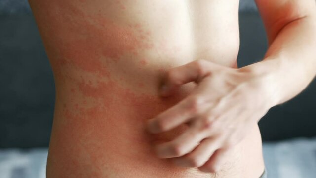 Close-up man scratches a red rash on his stomach in close-up. Allergies and skin diseases