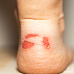 Big bloody callus on woman's heel  
