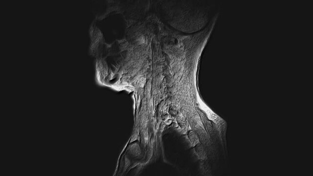 Voluminous MRI of the cervical spine, detection of protrusions and hernias