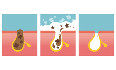 Pore cleansing, facial skin care image. Washing skin with soap. Vector illustration in flat cartoon style.