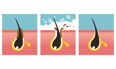 Haired pore cleansing, facial skin care image. Washing skin with soap. Vector illustration in flat cartoon style.