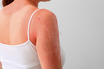 Woman with red sunburned skin against light background, closeup