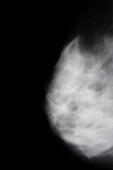 woman breast xray