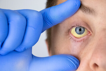 The yellow color of the male eye. Symptom of jaundice, hepatitis or problems with the gall bladder,...