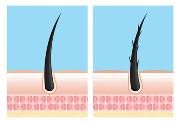 Hair care serum follicle diagnostics. Anatomy skin, medical human, epidermis layer, vector illustration design.