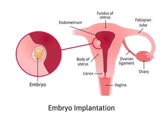 implantation. stage of pregnancy when embryo adheres to the wall of the uterus. Parts of uterus are marked with lines. Vector medical illustration.