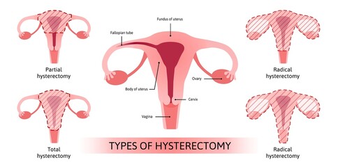 Hysterectomy, surgical removal of the uterus. Medical vector illustration shows 4 types of hysterectomy partial, total and two radical types. Removal of fallopian tubes, ovary.
